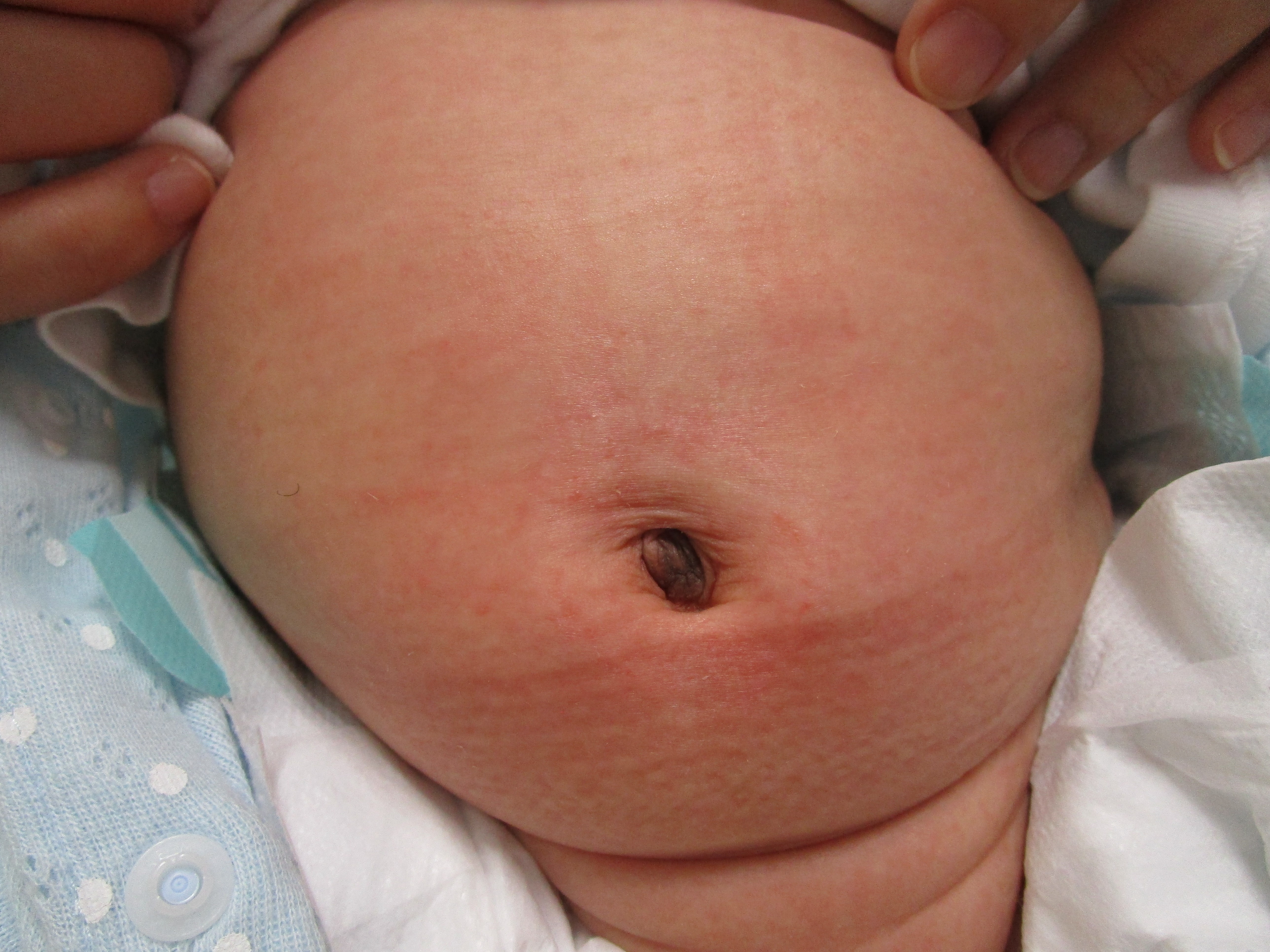 4週間で治療完了したところです 4週間で治療完了したところです